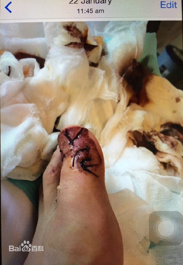 孙杨(Sun Yang)受伤性感图片图集