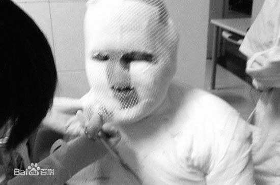 齐秦(Chyi Chin)意外烧伤图片图集