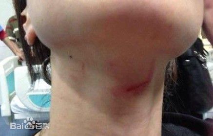 肖肖展示受伤照片素颜照壁纸