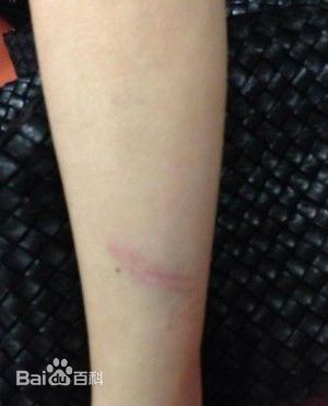 肖肖展示受伤照片素颜照壁纸